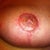 Left nipple graft 6 weeks post op
