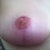 Right nipple graft 3.5 months post op