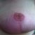 Left nipple graft 3.5 months post op
