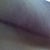 Right side incision 3.5 months post op