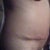 Side of view of scar and progress.. Still some swelling. I feel like I am doing really well so far.