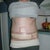 3 days post op - front