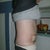 3 days post op