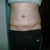 1 week post op