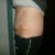 1 week post op