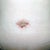 belly button 1 week post op, looks weird!!