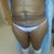 Before Surgery. Bye Bye Booty Stomach