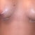 2 DAYS POST OP: I've been religiously putting the Arnica cream on them and I think it's been doing great..if nothing else, it soothes it very well.