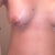 On the interior part of my right breast, theres a small stitch located there. I have to talk to my PS to see what that was all about. It used to be a mole but I dont know why stitches are protruding out of it..