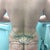 Before flank lipo and fat grafting