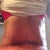I day post op, really swollen but much curvier!