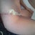 2 days post op
