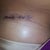 2 week incision left breast (under crease)