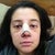 Post Op- Day 3