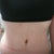 11 weeks post op