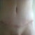 Tummy incision, 6 weeks