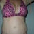 front view 7 months post op