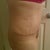 Post Op 7 weeks
standing straight and happy my V-JayJay and tummy is flat!
(CG marks - taken in the morning before the swelling begins)