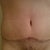 Post Op 7 weeks
Scar is starting to turn red (I hear one of the stages of scar healing...)