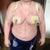 Two days post-op