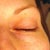 In this image I would like to draw attention to the patch of hypopigmentation underneath my eye. It is even shaped in the form of the head of the IPL.