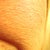 As you can clearly see, this picture, taken about a year and a half after my last IPL treatment, demonstrates that the damage intensifies as time progresses.