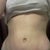 4weeks in my underwear. Can see part of scar at the midpoint where it's slightly higher