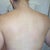 Post-op Day 2, backside. Minimal bruising from the flank lipo.