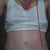 Post-op Day 3. Red, shiny, swollen belly