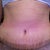 2 weeks post opp....NO DRAINS!!!