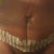 1.5 weeks Tummy Tuck