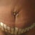 2 weeks Tummy Tuck