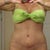 picture of my scar at 4 weeks post op looks pretty good i think