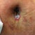 This is post opd 9 the clear string is the stitches the clear goo is the aquaphor. you can see how in the bottom its all bubbly and the inside is a darker shade. did I f-ed up?....