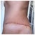 Almost 2 wks after revision