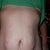 Close up, showing skin folds around bb and stretch marks.