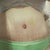 front 3 weeks po.... I still am swollen!! I am so ready for this whole adventure to be over!! It gets to me more than I thought it would.