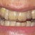 Aligner #13 Day 1 with pontic lateral incisor LHS