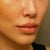 after juvederm in nasal folds and upper and lower lips, day 3