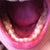 My bottom teeth; as you can see, my front bottom teeth have minor crowding.