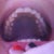 My top teeth; you can see how my lateral incisors are crowded, especially my right one.