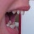 From the side, my lateral incisors look like a second canine. Yuck.