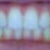 This is as good as it gets for me. Straight but my back teeth no longer touch, and i have a small open area on the right side.
