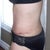 2 weeks Post Op scar and side view