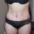 2 weeks Post Op front View. Still Swollen