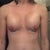 Post Op: Day 2 - Unwrapped to take first shower (48 hrs after surgery).