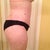 Post Op 8 weeks, right side