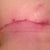 Post Op 8 weeks, left scar