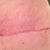 Post Op 8 weeks, left side & butt, scar