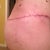 Post Op 8 weeks. left side & butt, scar